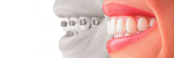 Alignements des dents avec des gouttières transparentes Rungis